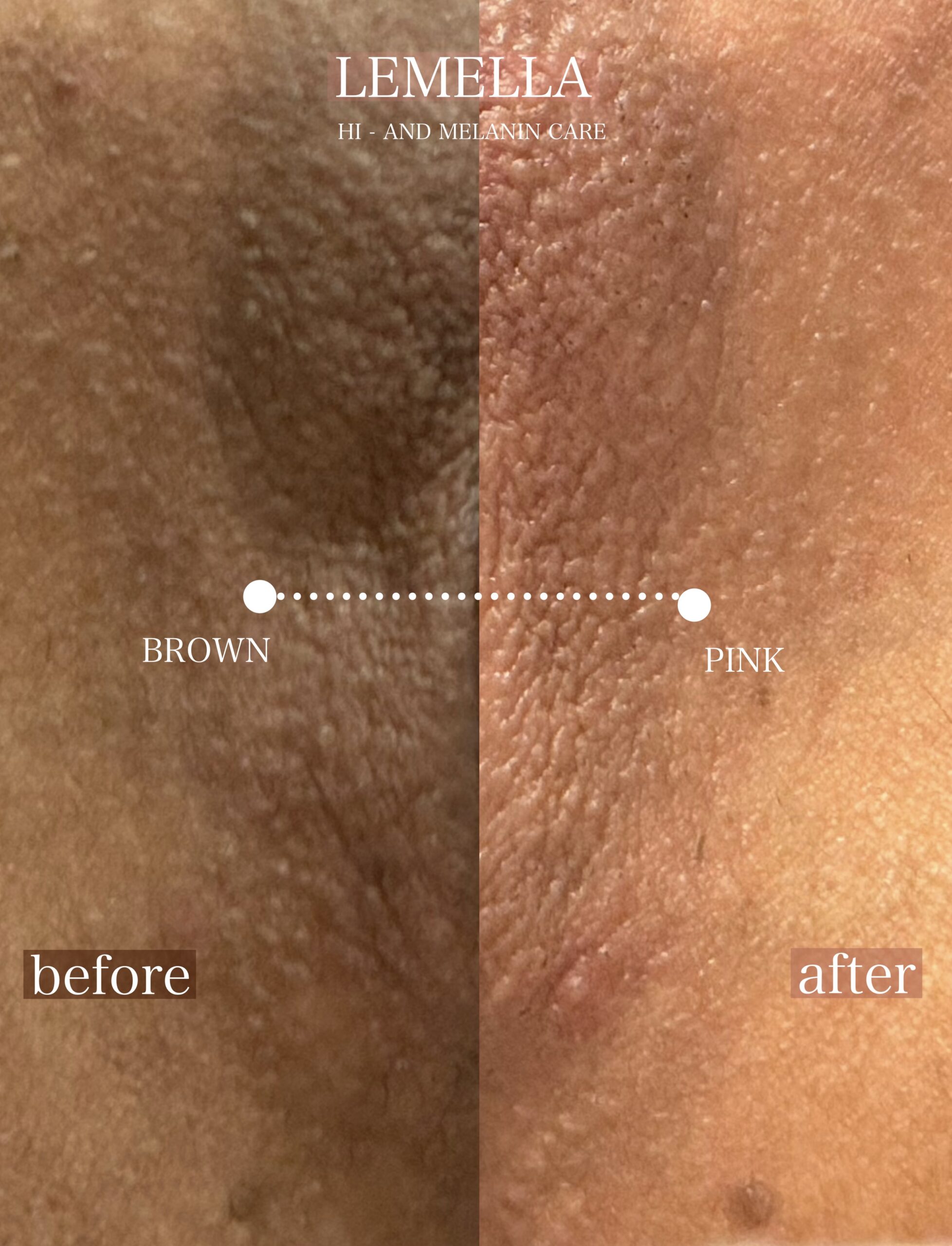 デリケートゾーン施術のビフォーアフター